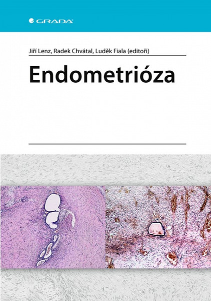 E-kniha Endometrióza